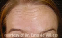 Botox02After