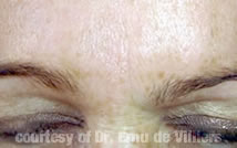Botox05After