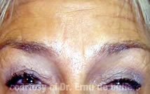 Botox09After