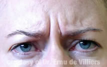 Botox01Before