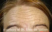 Botox02Before