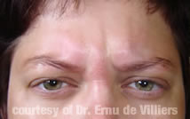 Botox03Before