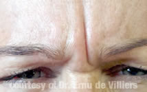 Botox05Before