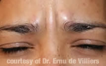 Botox08Before