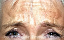 Botox09Before