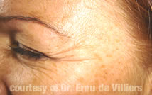 Botox10Before