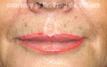 Filler05After