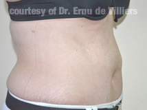 VaserLipoSculpt03After