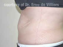 VaserLipoSculpt04After