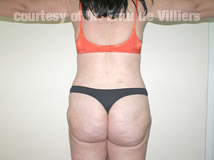 VaserLipoSculpt07After