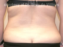 VaserLipoSculpt11After