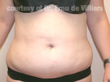 VaserLipoSculpt12After