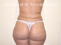 VaserLipoSculpt14After