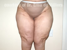 VaserLipoSculpt17After