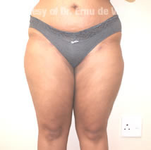 VaserLipoSculpt18After