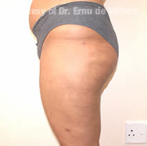 VaserLipoSculpt19After