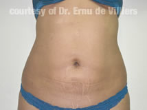 VaserLipoSculpt20After