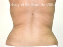 VaserLipoSculpt21After