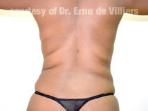 VaserLipoSculpt22After