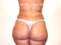 VaserLipoSculpt26After