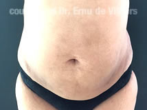 VaserLipoSculpt27After