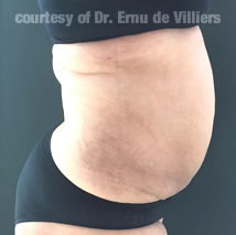 VaserLipoSculpt28After