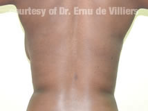 VaserLipoSculpt30After