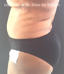 VaserLipoSculpt39After