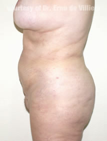 VaserLipoSculpt40After