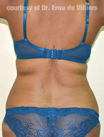 VaserLipoSculpt41After