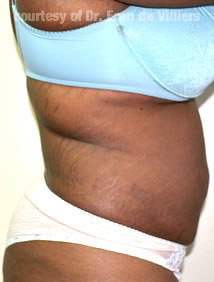 VaserLipoSculpt42After