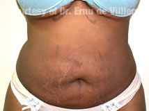 VaserLipoSculpt43After