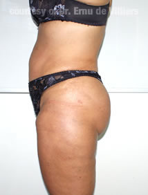 VaserLipoSculpt44After