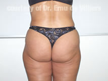 VaserLipoSculpt45After