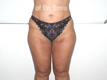 VaserLipoSculpt46After