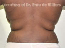 VaserLipoSculpt47After