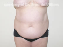 VaserLipoSculpt01Before