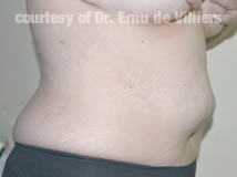 VaserLipoSculpt03Before