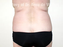 VaserLipoSculpt10Before