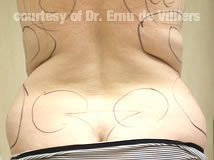 VaserLipoSculpt11Before