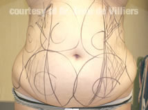 VaserLipoSculpt12Before