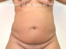 VaserLipoSculpt13Before