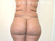 VaserLipoSculpt14Before