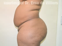 VaserLipoSculpt15Before