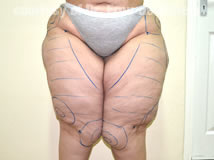 VaserLipoSculpt17Before