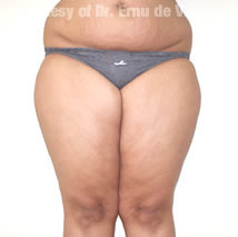 VaserLipoSculpt18Before