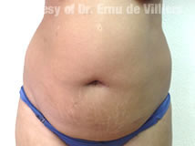 VaserLipoSculpt20Before