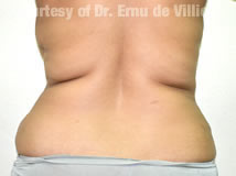 VaserLipoSculpt21Before