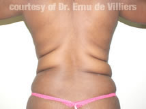 VaserLipoSculpt22Before