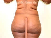 VaserLipoSculpt26Before